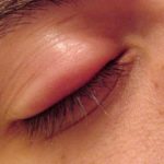 Swollen upper Eyelid Picture