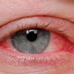 Symptoms of Pink Eye