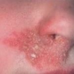 Dry Flaky Skin around Nose