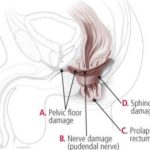 Fecal Incontinence Meaning