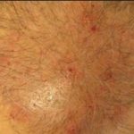 Hair Follicle Infection on Scalp