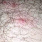 Infected Hair Follicle on Groins