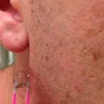 Ingrown Facial Hair