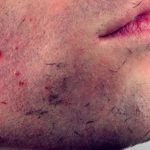 Ingrown Facial Hair Bump