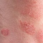 Itchy Red Patches on Skin could be Eczema or Psoriasis Pictures