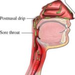 Post Nasal Drip and Sore Throat could be the cause of Smelly Mucus in your Nose