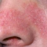 Red Dry Skin around Skin