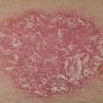 Red Patches on Skin, chronic Psoriasis