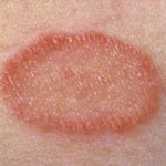 Red Ptaches on Skin, Pityriasis Rosea Picture