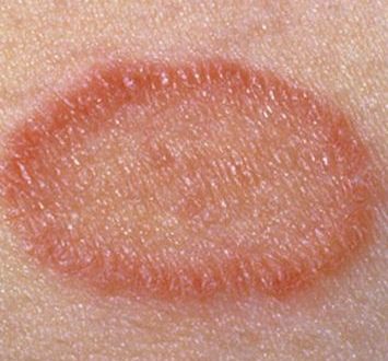 Red Patches on Skin, Causes, Pictures, Itchy, Painful, Not Itchy or ...