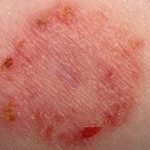 Ringworm is a common cause for ring like rash or Patch on skin