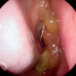 Smelly Mucus in Nose caused by Nasal Polyps