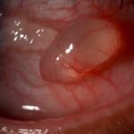 A Cyst on Eyeball Picture