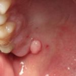 A Lump on Roof of Mouth could be Fibroma