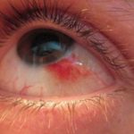 Bubble on Eyeball could be an Allergy