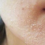 Causes of Dry Flaky Skin on Face