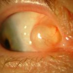 Cyst on Eyeball Picture