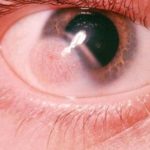 Dermoid Cyst on Eyeball