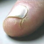 Dry Cracked SKin around Nail