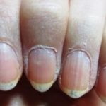 Dry Skin around Fingernails