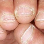 Dry Skin around Nails