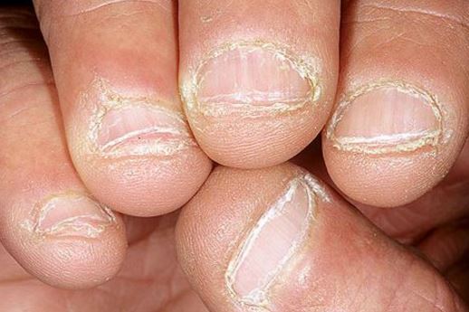 dry-skin-around-nails-vitamin-deficiency-hard-peeling-skin-causes