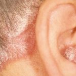 Dry Skin behind Ears could be Psoriasis