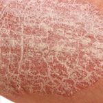 Dry Skin on Legs Picture