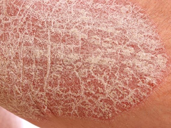 Dry Skin Patches On Legs Diabetes