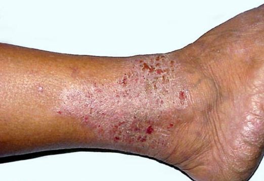 stasis-dermatitis-on-legs-pictures-174-photos-images-illnessee