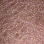 Extremely Dry Skin on Legs looks like Scales