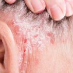 Flaky Skin behind Ear