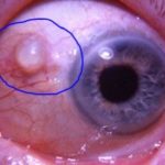 Fluid – Filled Cyst on Eyeball