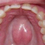 Hard Lump on Roof of Mouth