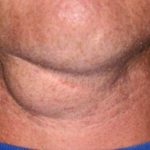 Lump under Chin near Throat