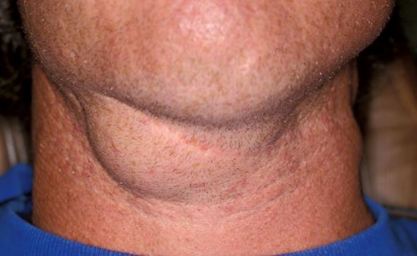 Lump Under Chin Bone Near Throat Neck Cancer Cold Sore Right Or 