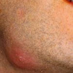 Painful Lump under Chin