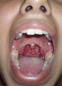 throat gag hd
