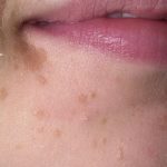 Flat Warts on Face Picture