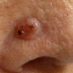 Nose Piercing Bump Infection