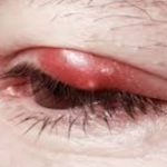 Stye on Eyelid Picture