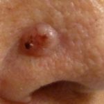 Lump on Nose after Piercing