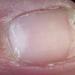 Nail Splitting, Cracked causes