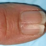 Nail Splitting Down Middle