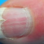 Nail Splitting could be Vitamin deficieny