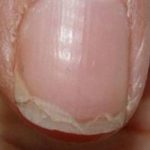 Peeling Nail Causes