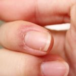 Skin Peeling around Nails