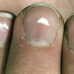 White Spots on Nails Meaning