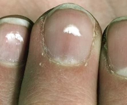 White Spots on Nails Meaning