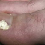 White Spots on Toenail due to Fungal infection Picture